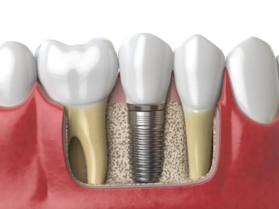 Dental Implant Placed Between Two Healthy Teeth With Bone Grafting