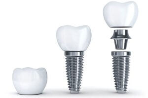 A Step by Step Guide to Dental Implants