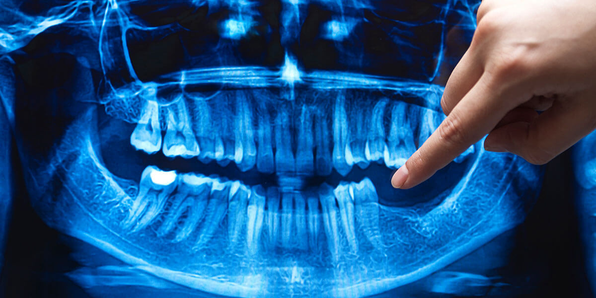 Smiling Patient Ridge Preservation