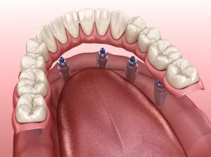 Graphic Showing Dental Implants