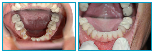 Before & After Ceramic Crowns in Scarsdale