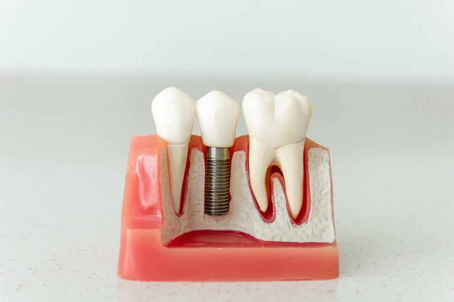 How Much Do Dental Implants Cost in Scarsdale?