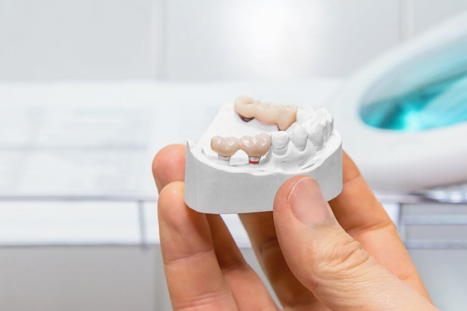How Much Does A Dental Bridge Cost in Scarsdale, NY?