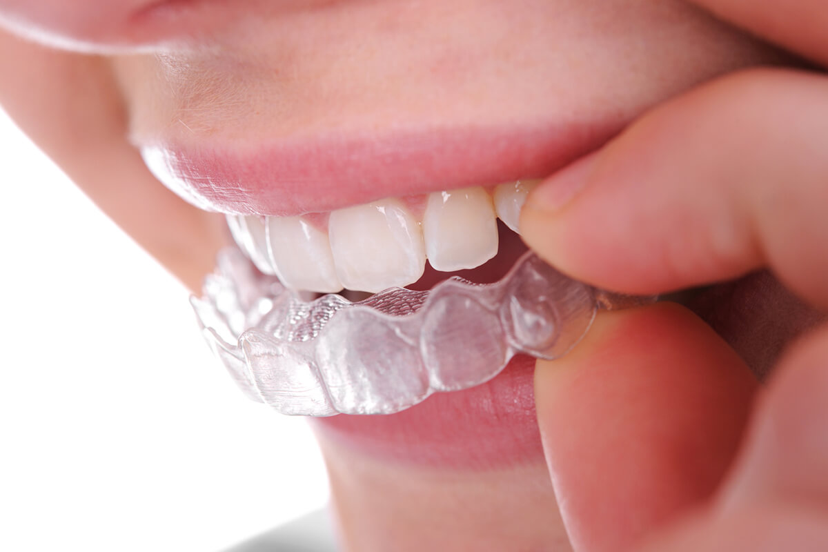 How Much Is Invisalign?