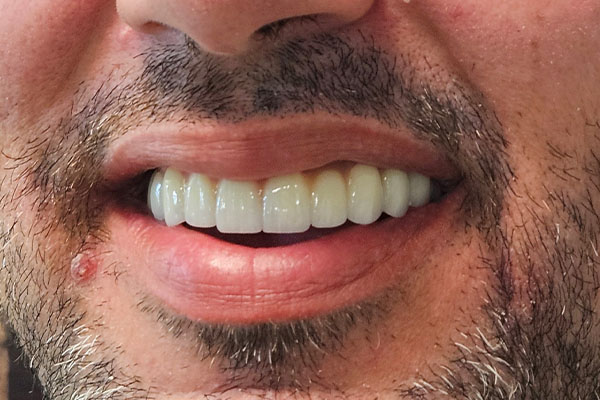 Implant Supported Dentures Patient