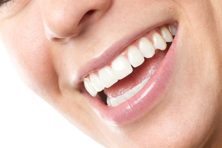 Person smiling veneers