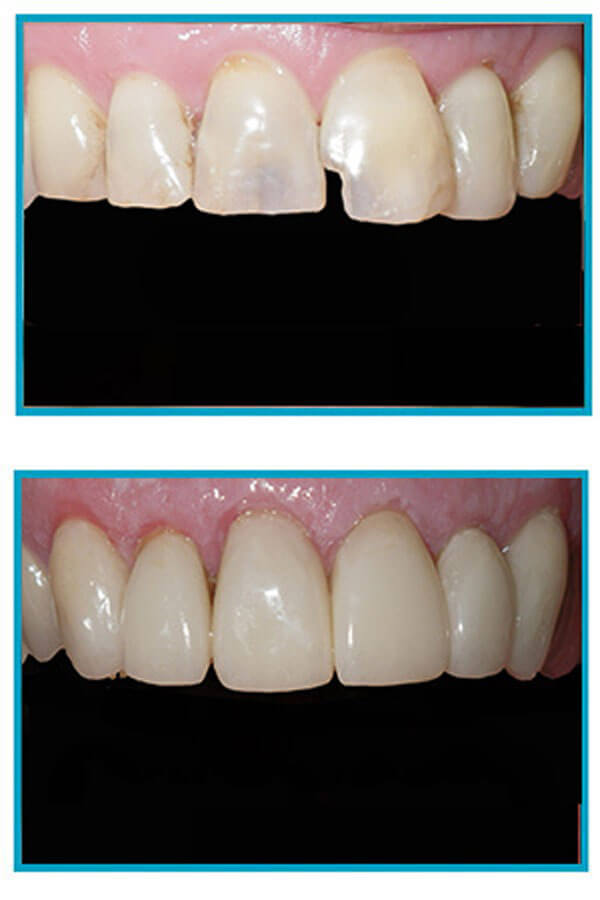 Porcelain Veneers