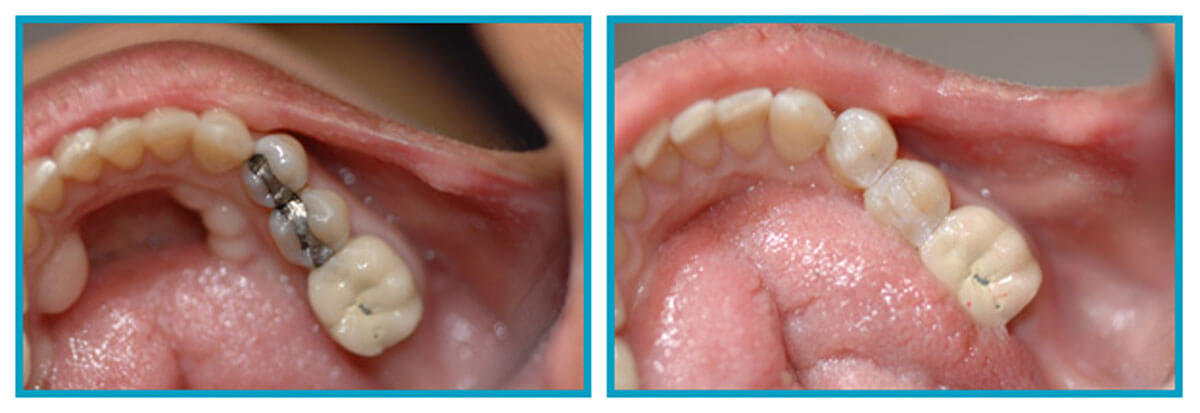 Before & After Composite Fillings in Scarsdale