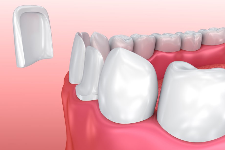 What to Expect After Getting Veneers: Recovery, Sensitivity & Adjustments
